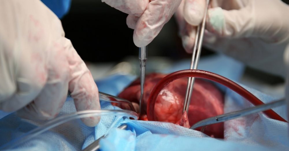 Hospital São Braz em Porto União realiza primeira captação de coração para transplante